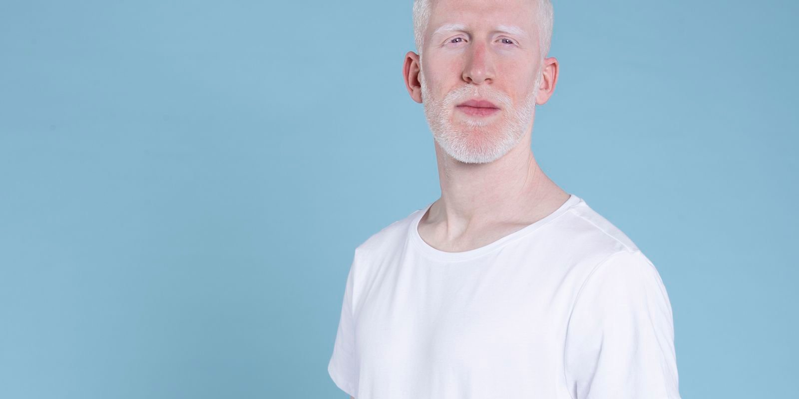 homem albino.jpg